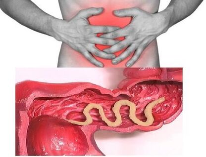 I segni dell'elmintiasi cronica sono la malattia intestinale dispeptica