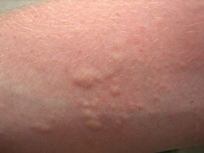 Le eruzioni allergiche pruriginose possono essere sintomi di ascariasis