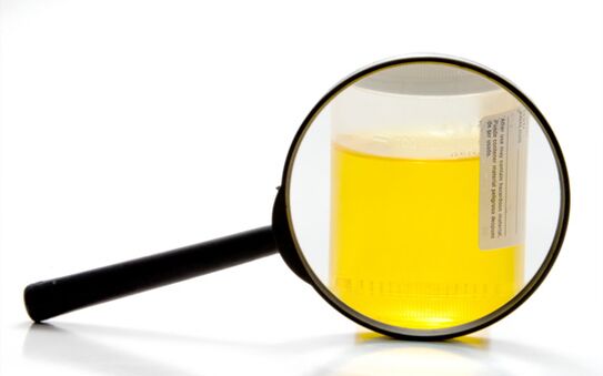 Analisi delle urine per diagnosticare la schistosomiasi
