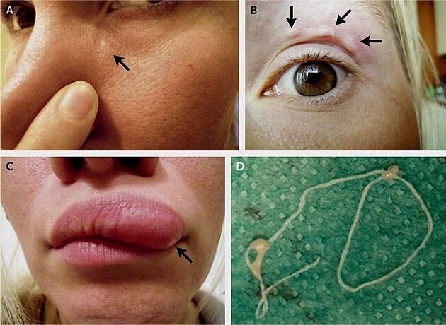 Le principali manifestazioni della dirofilariosi sul viso